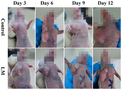 Liquid metal injected from interstitial channels for inhibiting subcutaneous hepatoma growth and improving MRI/MAT image contrast